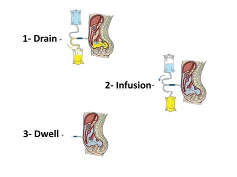 Ppt Peritoneal Dialysis Powerpoint Presentation Free Download Id 3754765