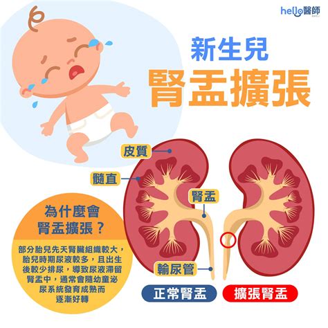 新生兒腎盂擴張別慌張，定期接受腎臟超音波檢查就ok！