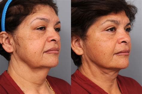 Naturalift Mini Facelift Before After Patient 79 NYC Dr Thomas