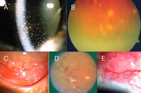 Sarcoidosis Ophtnotes