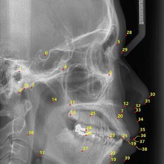 An example case of forty-two landmarks (numbered 0–41) in a ...