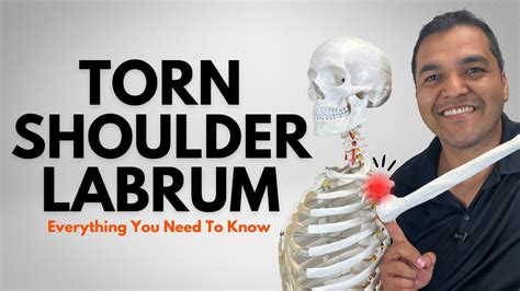 Torn Shoulder Labrum Everything You Need To Know Diagnosis