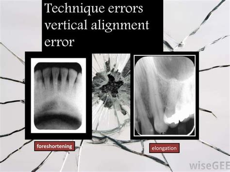 Artifact And Errors In Intraoral Periapical Radiograph Ppt