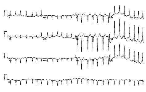 Atrial Fibrillation With Rapid Ventricular Response