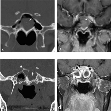 Inflammatory Isolated Sphenoid Sinus Diseases Aeb A Case Of