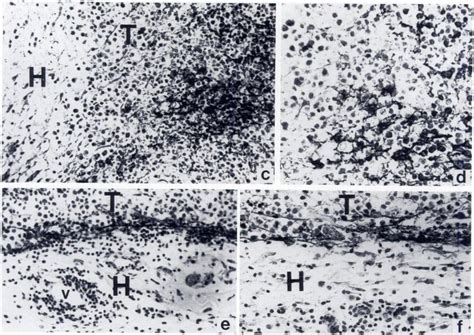 Immunoperoxidase Localization Of Fibrinogen Fibrin In Lewis Lung A And