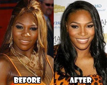 Serena Williams before and after plastic surgery 04 – Celebrity plastic ...