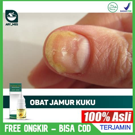 Jual Obat Jamur Kuku Tangan Dan Kaki Kuku Rusak Bergelombang Jamuran