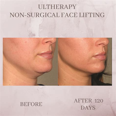 Ultherapy Eluma Laser Aesthetics