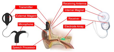 Cochlear Implant Eeweb