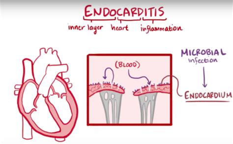 Infective Endocarditis Flashcards Quizlet