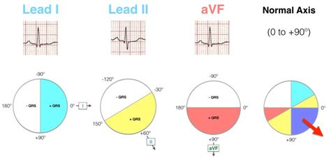 Ecg Axis Interpretation • Litfl Medical Blog • Ecg Library Basics