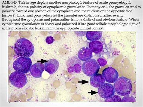 Department Of Pathological Anatomy Acute Myeloid Leukemia Prepared