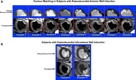 A , Image-pairs in 8 canines with subendocardial infarction of the... | Download Scientific Diagram