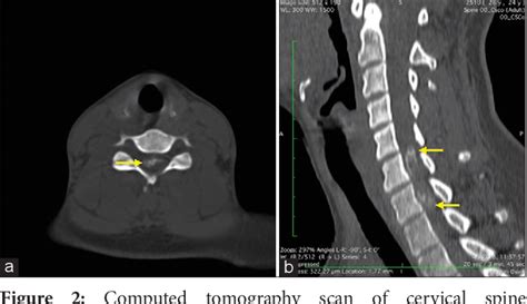 Pdf Cervical Intra Extradural Meningioma With En Plaque Dumbbell