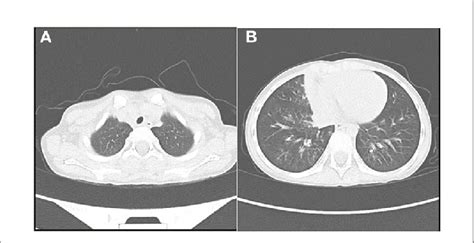 Figure E Patient S Chest Ct Showed A Few Inflammatory Lesions In The Download Scientific