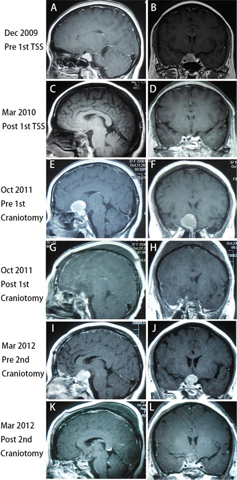 Preoperative Sagittal A And Coronal B Planes Of Magnetic Resonance