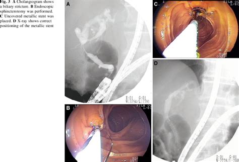 A Cholangiogram Shows A Biliary Stricture B Endoscopic Sphincterotomy