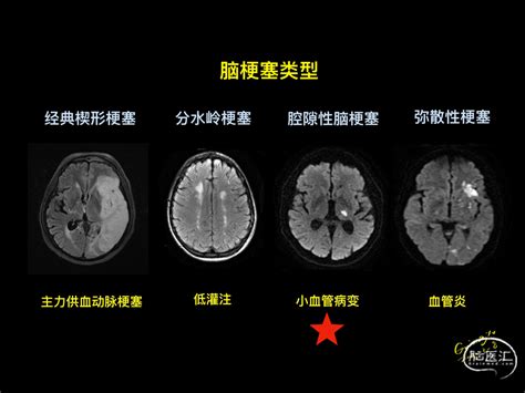 腔隙性脑梗塞show 脑医汇 神外资讯 神介资讯