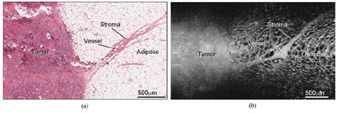 Imaging Of Breast Cancer With Optical Coherence Tomography Needle