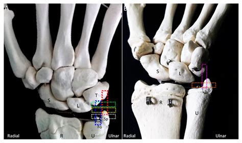 Ulnar Collateral Ligament Wrist