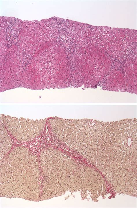 Low Power Images Of Liver Core Biopsy H E And Elastica Stain Both