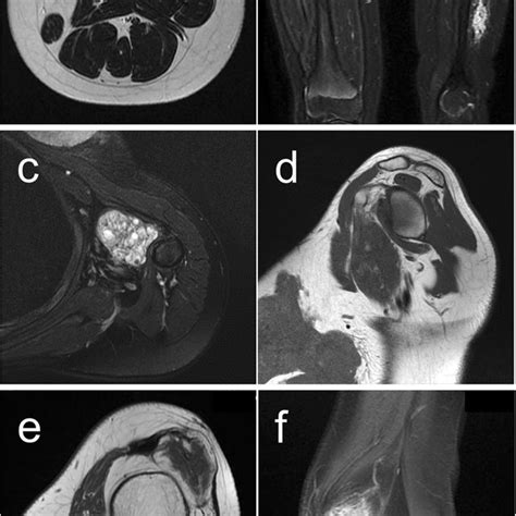 Magnetic Resonance Imaging MRI Axial T2 Weighted MRI A And Coronal