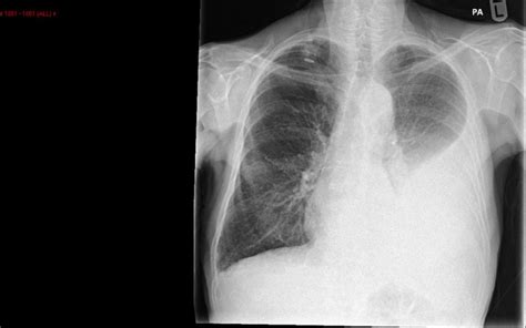 Pleural Effusion Fluid In The Pleural Space Sleep And Lung Care