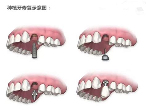 年龄大了，缺牙怎么办，这三种镶牙方式怎么选？