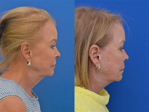 Facelift Before And After Pictures Case 12 Charlotte Nc Dilworth Facial Plastic Surgery