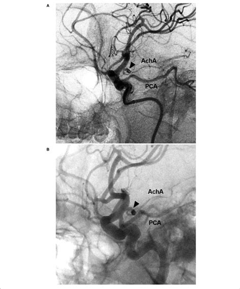 Evt Of The Acha Aneurysm With Recurrence A Dsa Of The Ica Showing