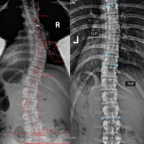 Strauss Scoliosis Correction Keeping Patients Ahead Of The Curve