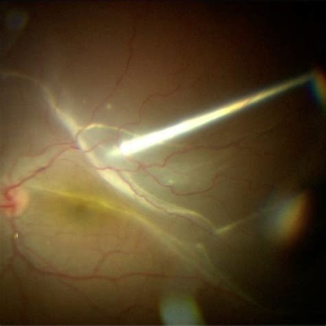 Surgical View Of The Posterior Segment In A Case Of Rrd With Subretinal