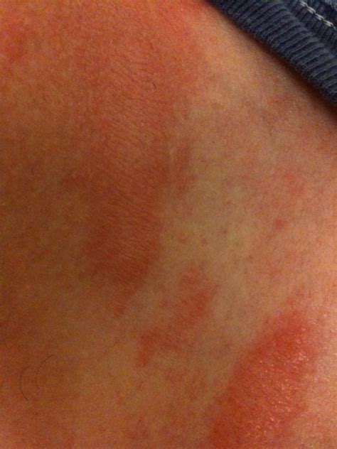 Red Itchy Rash On Neck