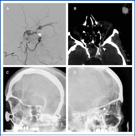 Figure 1 From Using Xperguide Planning Software To Safely Guide Catheter Access To The Cavernous