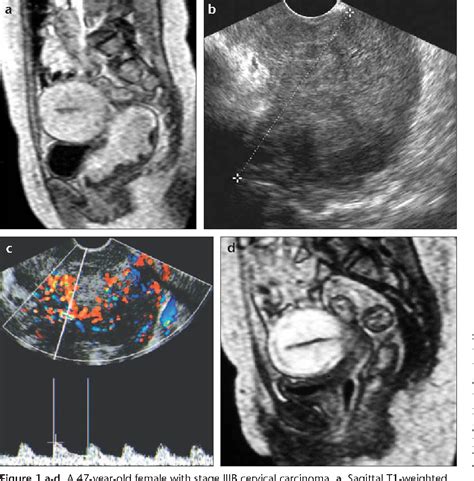 Figure 1 From Evaluation Of Radiotherapy Response Of Cervical Carcinoma