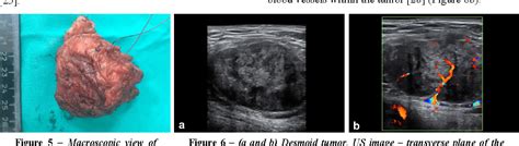 Figure 5 From Abdominal Wall Endometriosis Versus Desmoid Tumor A Challenging Differential