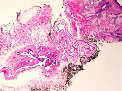 Which Classification Is Harder Skin Adnexal Tumors Or Interstitial