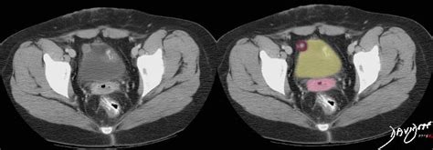 √ Uterus Endometriosis Ct Scan / Tumors Of The Uterine Corpus Clinical ...