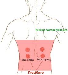 Люмбаго - симптомы, диагностика, лечение » Клиника Доктора Игнатьева