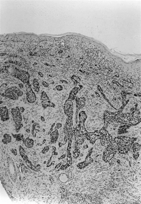 Immunohistochemical Nuclear Staining For P Pcna And Ki In