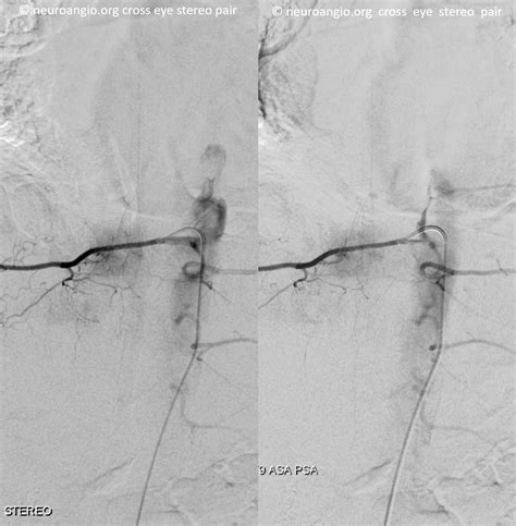 Anterior Spinal Artery Angiogram