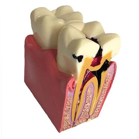 Buy FXQ Teeth Teaching Models Denture Teeth Model Caries Comparison