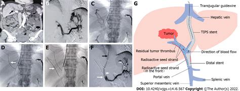 Transjugular Intrahepatic Portosystemic Shunt Diagram