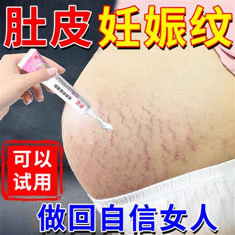 产后妊辰纹消除去妊娠纹紧致肚皮修复霜术后去疤痕增生祛除疤膏yy虎窝淘