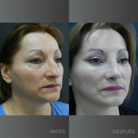 Gallery Facial Lifting Doctor Alberto Arévalo