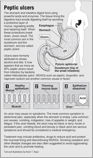 Ulcers Peptic Pointfinder Health Infographics