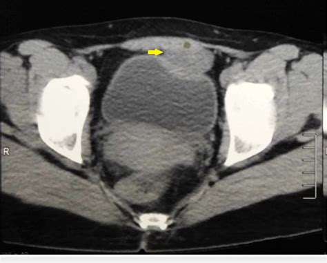 Transverse Section Of The Ct Showing The Urachal Cyst Arrow Anterior