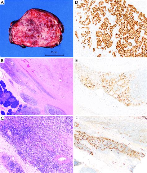 Case 1 Resection Gross Examination Of The Resection Specimen Showed A Download Scientific