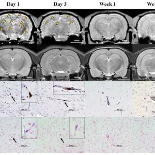 In Vivo Cellular Mri With Histological Validation Of Brain Metastases